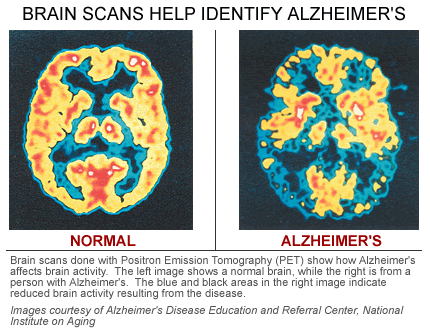 Changes in the brain due to Alzheimer's